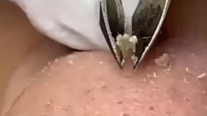 #210 Чистка лица от угрей и акне. Выдавливание прыщей. Удаление черных точек и комедонов