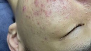 042 • Relax Spa • АСМР • Acne collection