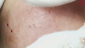 Лечение закрытых комедонов и милиумов