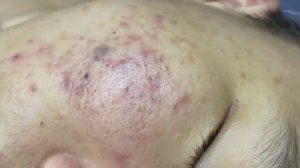 041 • Relax Spa • АСМР • Acne collection