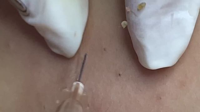 Удаление скопление черных точек – очищение закупоренной кожи