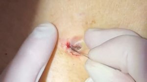 Выдавливание прыщей, угрей, черных точек и камедонов #307