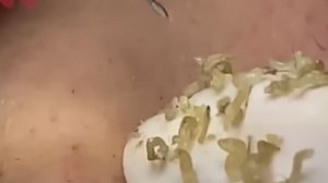 #208 Чистка лица от угрей и акне. Выдавливание прыщей. Удаление черных точек и комедонов