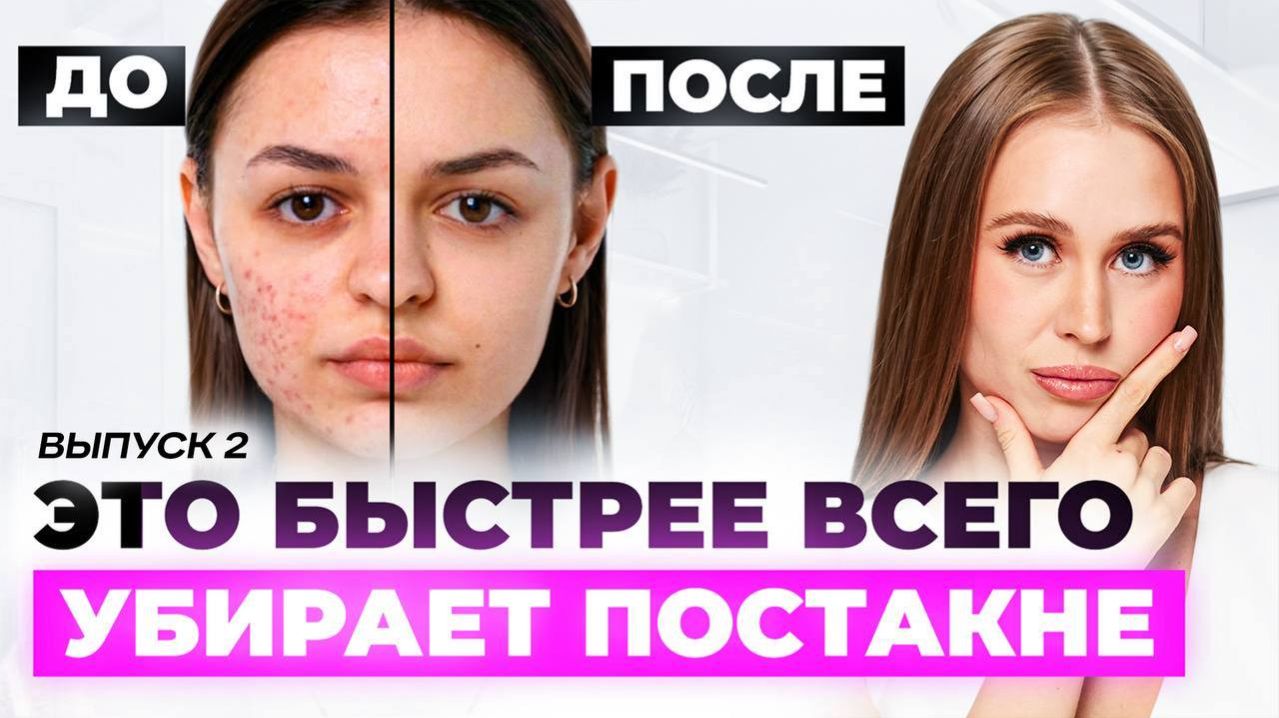 Изменили в уходе ЭТО и ПОСТАКНЕ УШЛО! Пошаговый план как убрать рубцы и высыпания дома