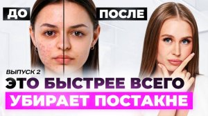 Изменили в уходе ЭТО и ПОСТАКНЕ УШЛО! Пошаговый план как убрать рубцы и высыпания дома