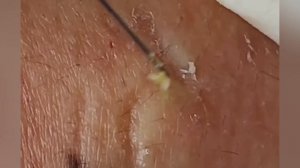 Выдавливание прыщей, угрей, черных точек и камедонов #308