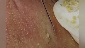 Выдавливание прыщей, угрей, черных точек и камедонов #309