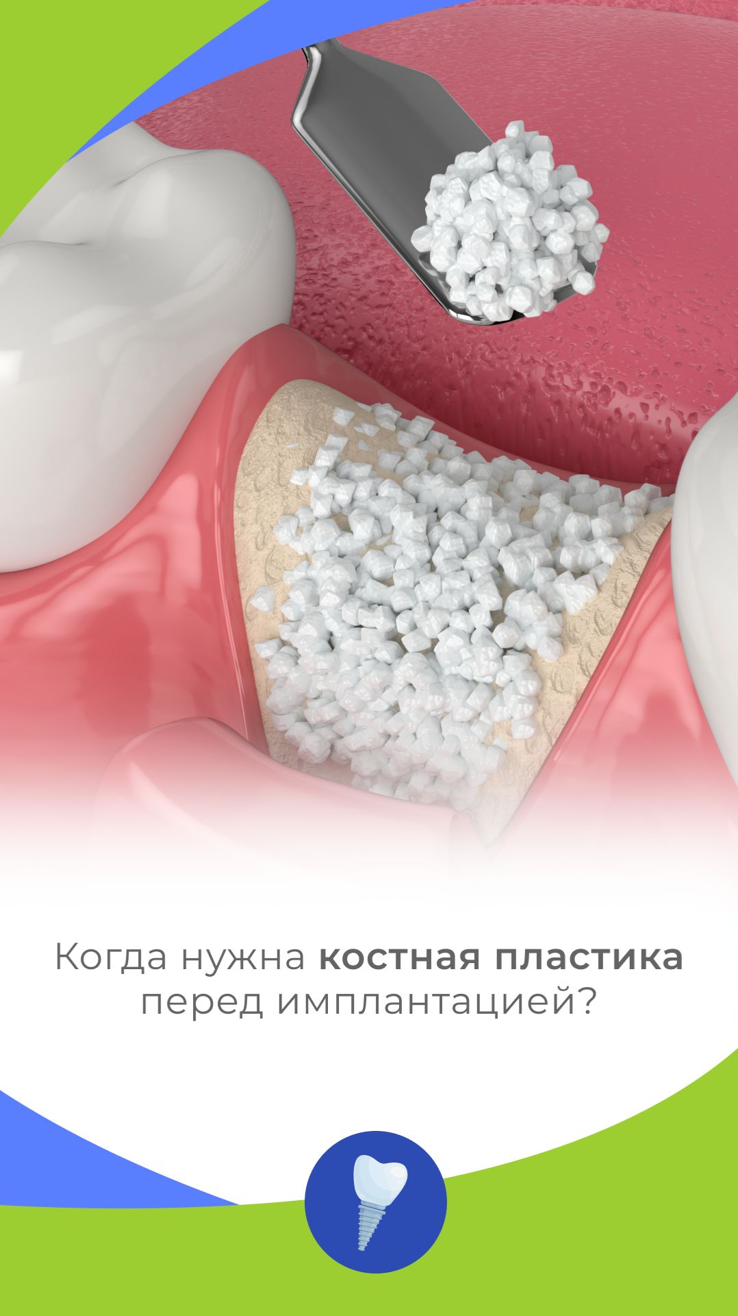 Когда нужна костная пластика перед имплантацией?