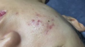 043 • Relax Spa • АСМР • Acne collection