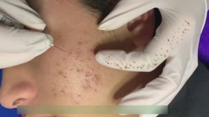 Борьба с акне: удаление воспалений и комедонов. #акне #прыщи #чисткалица