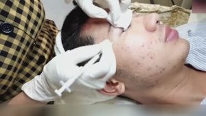 Удаление закрытых комедонов и подкожных угрей в области щёк