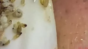 #209 Чистка лица от угрей и акне. Выдавливание прыщей. Удаление черных точек и комедонов