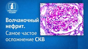 Волчаночный нефрит