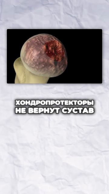 Почему хондропротекторы не работают?
