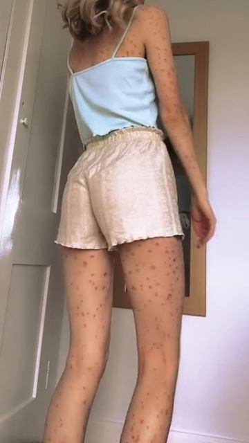 Высыпания на коже — крик изнутри. Перестань замазывать, начни слушать. Лекция в шапке 👆