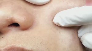 Удаление комедонов. Расслабляющий видеоролик #комедоны #уходзалицом