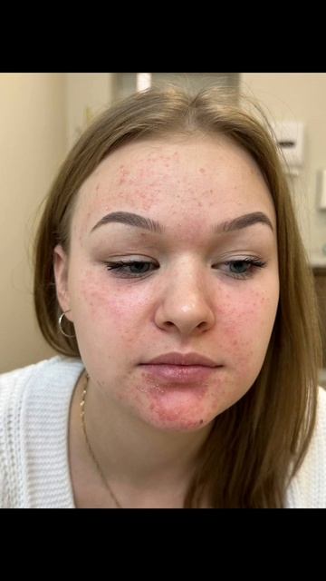 Лечение периорального дерматита