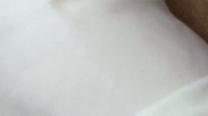 Выдавливание прыщей, угрей, черных точек и камедонов #311