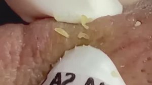 #211 Чистка лица от угрей и акне. Выдавливание прыщей. Удаление черных точек и комедонов