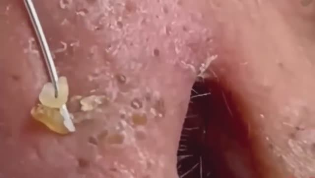 #213 Чистка лица от угрей и акне. Выдавливание прыщей. Удаление черных точек и комедонов