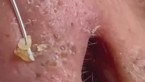 #213 Чистка лица от угрей и акне. Выдавливание прыщей. Удаление черных точек и комедонов