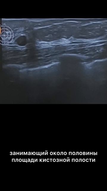 #внутрипротоковая папиллома