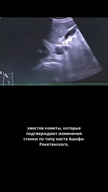 #аденомиомвтоз