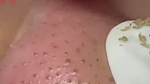 #212 Чистка лица от угрей и акне. Выдавливание прыщей. Удаление черных точек и комедонов