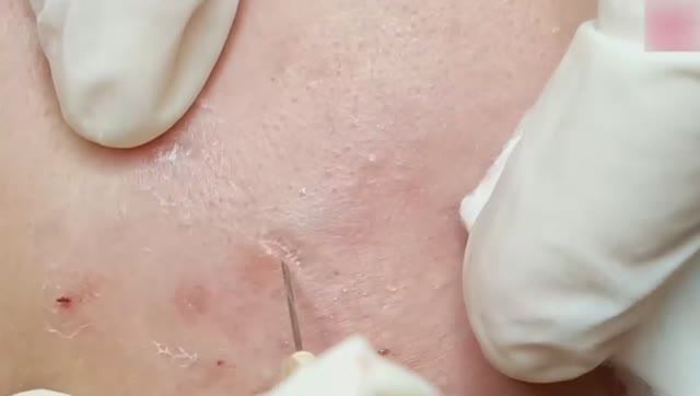 Лечение закрытых комедонов и подкожных угрей