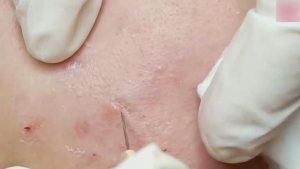 Лечение закрытых комедонов и подкожных угрей