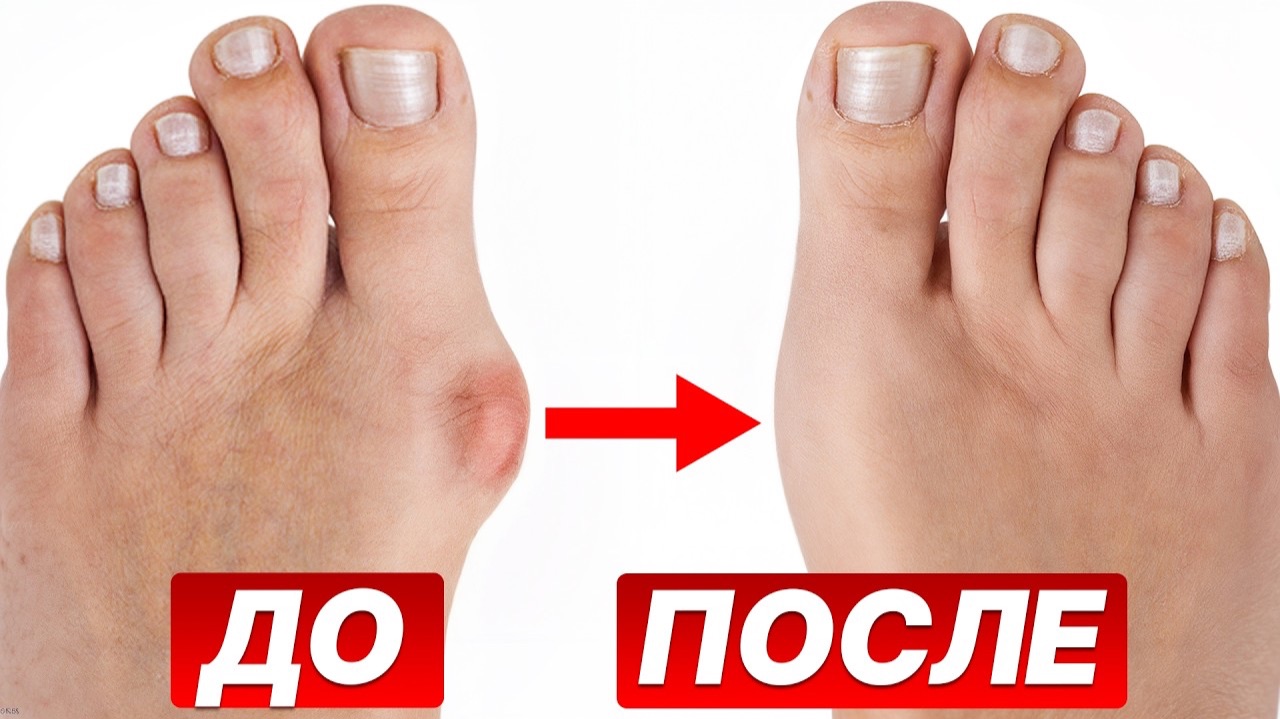Шишка на большом пальце УШЛА! Как ЛЕГКО избавиться от косточки на ноге?