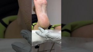 Фруктовый педикюр. Модель с микозом и повышенным сахаром