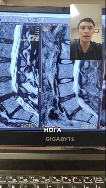 Грыжа 10 мм — врач назначил операцию. А она не нужна!