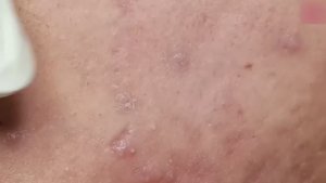 Полное лечение акне. От воспаления до чистой кожи. #лечениеакне #чисткалица #проблемнаякожа