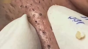 Профессиональное избавление от комедонов и acne #887573