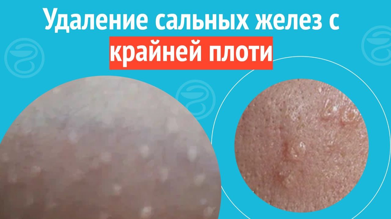 ✅ Удаление сальных желез с крайней плоти. Клинический случай №1511 смотреть онлайн