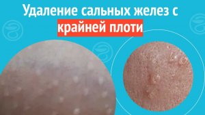 ✅ Удаление сальных желез с крайней плоти. Клинический случай №1511