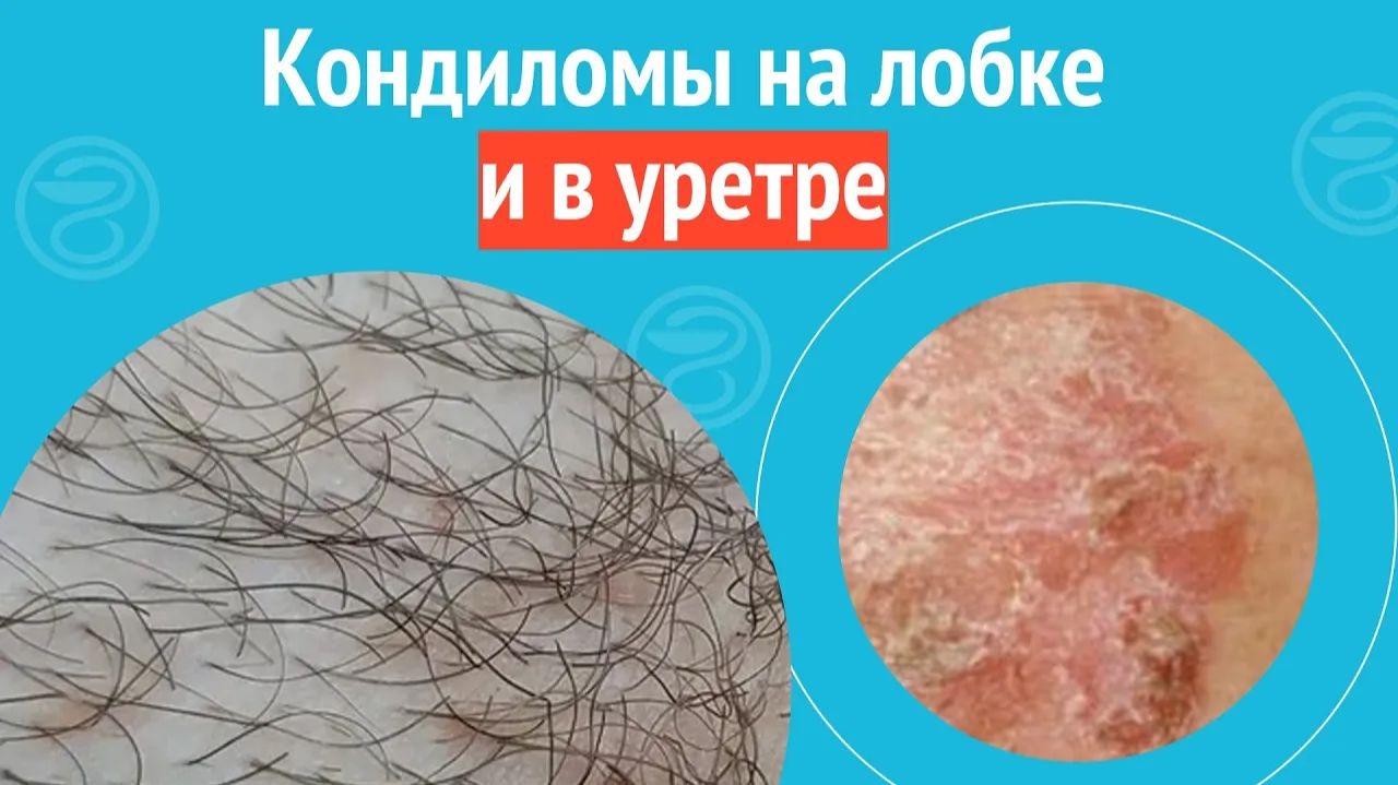 😧 Кондиломы на лобке и в уретре. Клинический случай №1503 смотреть онлайн