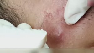 Терапия акне: глубокое очищение и восстановление. #акне #постакне #уходзалицом