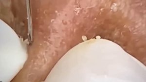 #214 Чистка лица от угрей и акне. Выдавливание прыщей. Удаление черных точек и комедонов