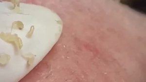 #215 Чистка лица от угрей и акне. Выдавливание прыщей. Удаление черных точек и комедонов