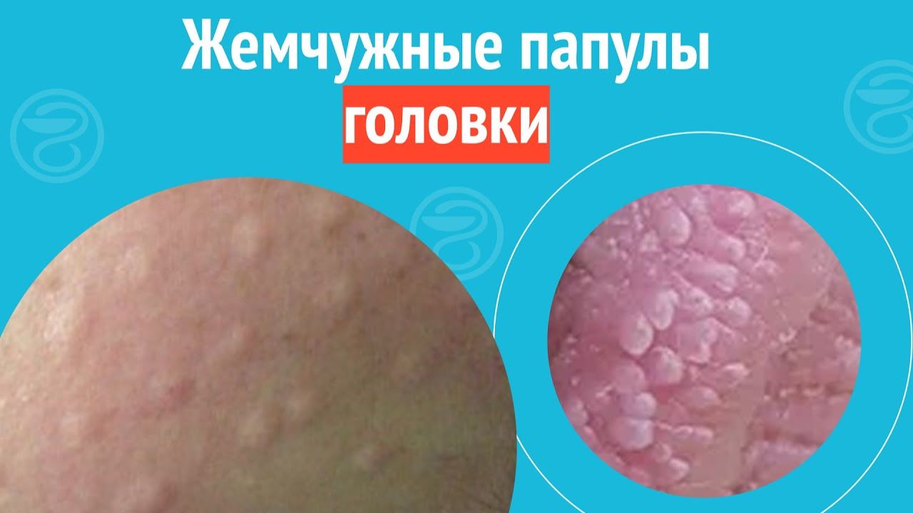 ▶️ Жемчужные папулы головки. Клинический случай №1496 смотреть онлайн
