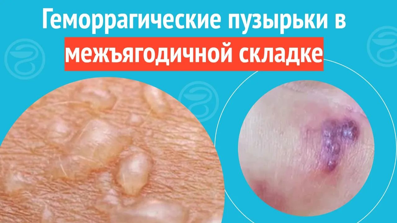 😨 Геморрагические пузырьки в межъягодичной складке. Клинический случай №1502 смотреть онлайн