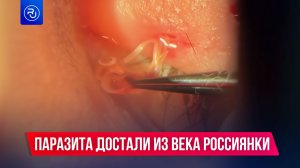 Огромного паразита достали из века девушки в Дагестане