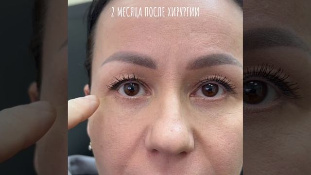 2,5 месяца после операции нижняя блефаропластика