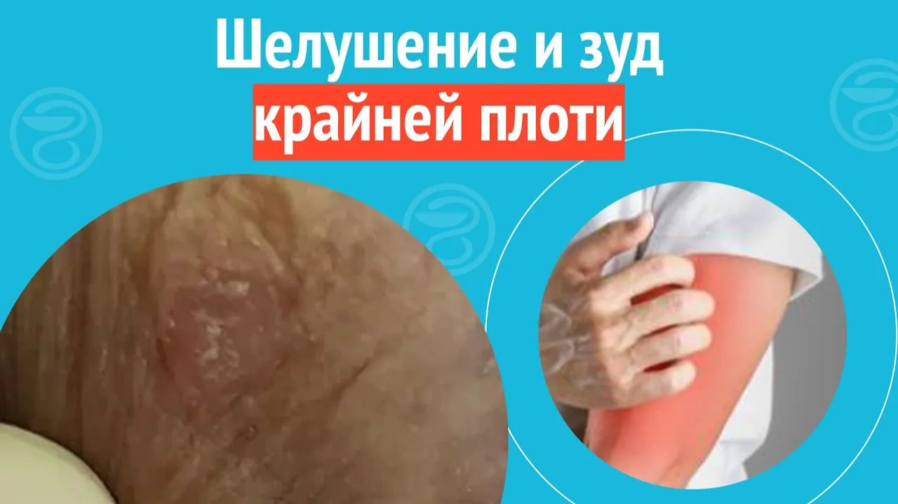 😯 Шелушение и зуд крайней плоти. Клинический случай №1510 смотреть онлайн