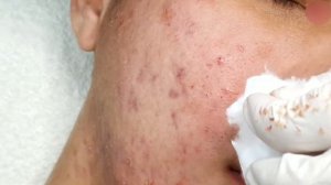 Лечение запущенного акне. Множественные воспаления и их устранение. #лечениеакне #чисткалица #прыщи