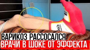 Рассказал всем знакомым! От ВАРИКОЗА не осталось и следа