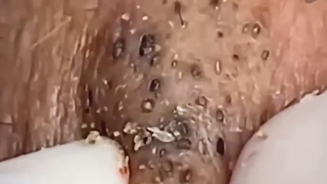 #216 Чистка лица от угрей и акне. Выдавливание прыщей. Удаление черных точек и комедонов