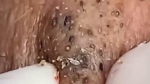 #216 Чистка лица от угрей и акне. Выдавливание прыщей. Удаление черных точек и комедонов